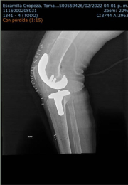 Rx lateral con prótesis de rodilla navegada - Ortopedista - Dr. Jorge Alberto Leyva Medellín - Puebl...