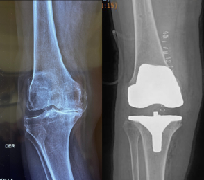 Rx comparativas, antes de la cirugía y después ya con prótesis - Ortopedista - Dr. Jorge Alberto Ley...
