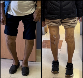 Imagen comparativa que demuestra alineación satisfactoria de rodilla derecha - Ortopedista - Dr. Jor...