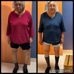 Foto comparativa post operada de 3 semanas de evolución sin dolor, con buena alineación y muy buena ...