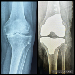 Rx comparativa, lado izquierda imagen prequirurgica con desgaste articular, deformidad, con osteólog...
