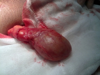 TESTICULO DISECADO. - Urólogo - Dr. Félix Padilla Acevedo - Puebla