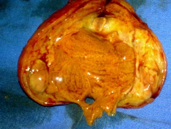 TESTICULO CON CARACTERISTICAS MACROSCOPICAS DE SEMINOMA - Urólogo - Dr. Félix Padilla Acevedo - Pueb...