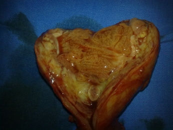TESTICULO CON CARACTERISTICAS MACROSCOPICAS DE SEMINOMA - Urólogo - Dr. Félix Padilla Acevedo - Pueb...